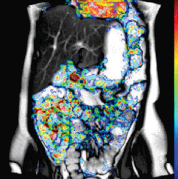 Imagen B: Mapa paramétrico codificado por color de movimiento de pixel cuantificado por software durante una película de motilidad coronaria de respiración sostenida de 20-segundos del intestino delgado (Fotografía cortesía de A. Menys y S.A. Taylor, Hospital del Colegio Universitario, Londres, Reino Unido).